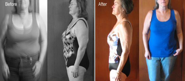 before after hcg chicago